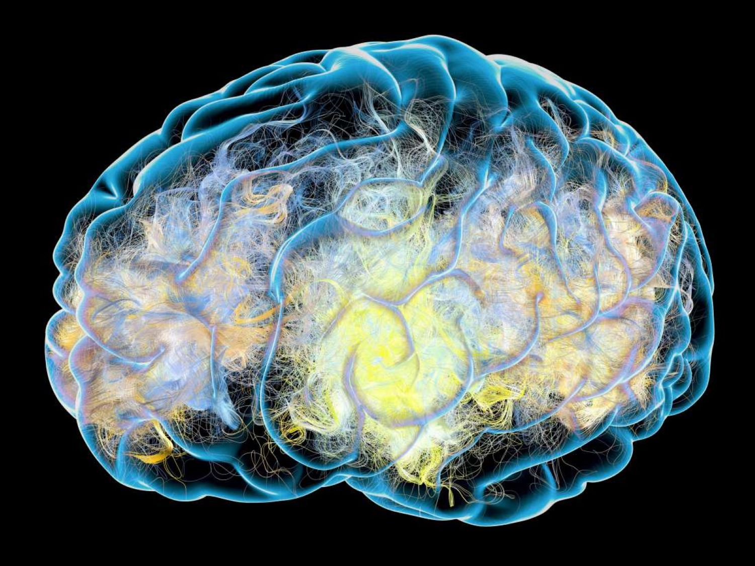 Brain activity Parkinsons image